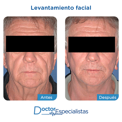 Lifting Facial En Veracruz, Ritidectomia