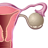 Imagen ilustrativa para quistes ovaricos