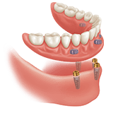 Imagen ilustrativa de dentadura sobre implantes