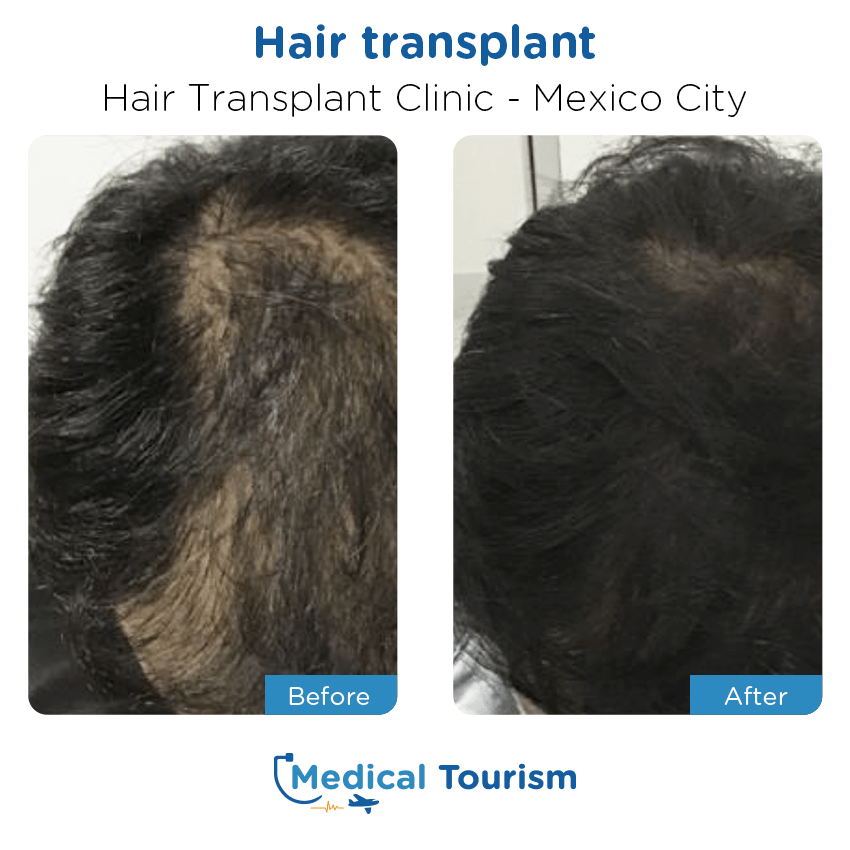 Injerto de cabello antes y despues de pacientes Ciudad de Mexico