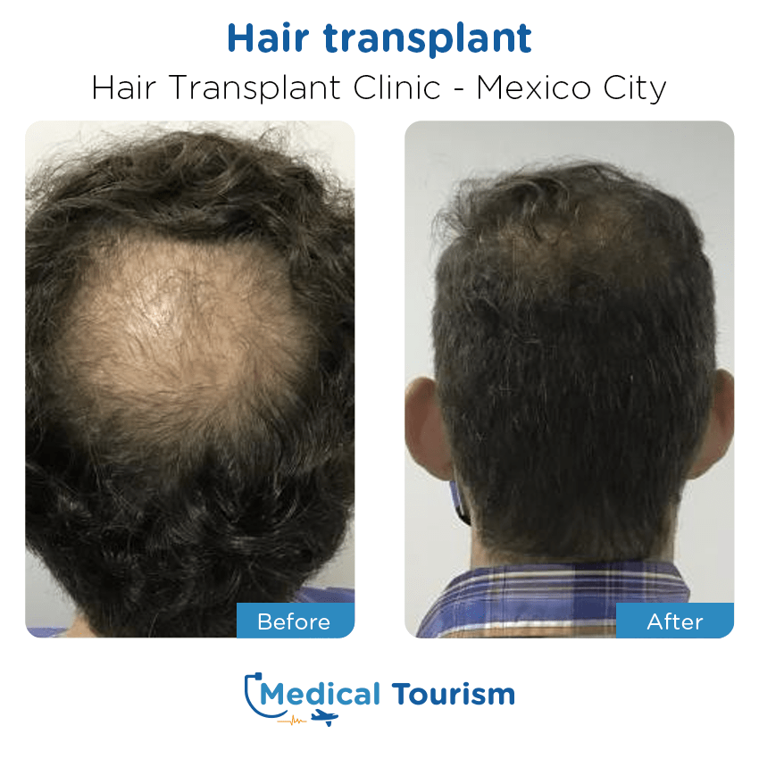 Injerto de cabello antes y despues de pacientes Ciudad de Mexico